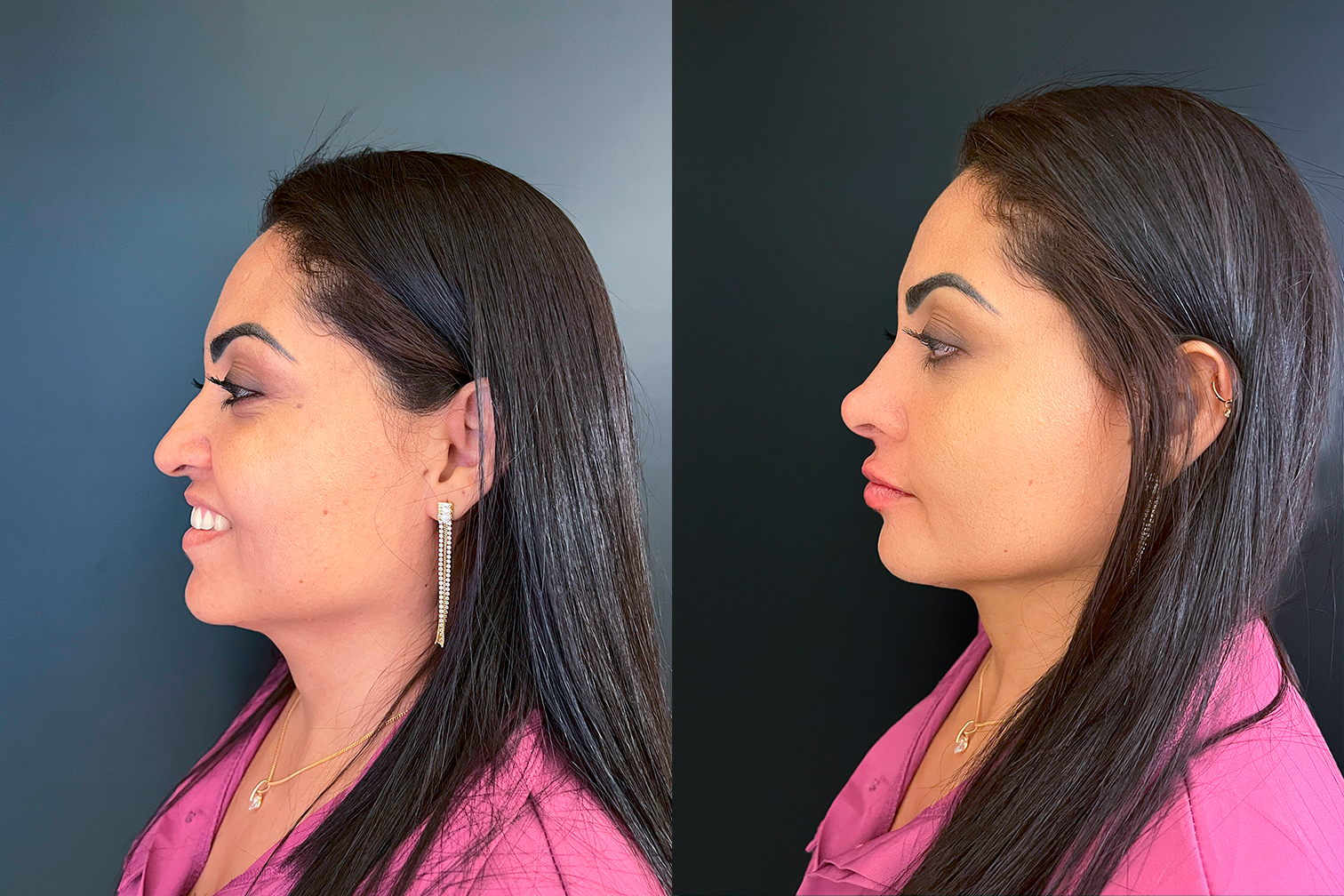 PROTOCOLO LM BEAUTY - ANTES E DEPOIS 1