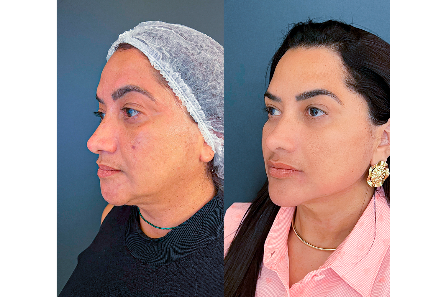 PROTOCOLO LM BEAUTY - ANTES E DEPOIS 10