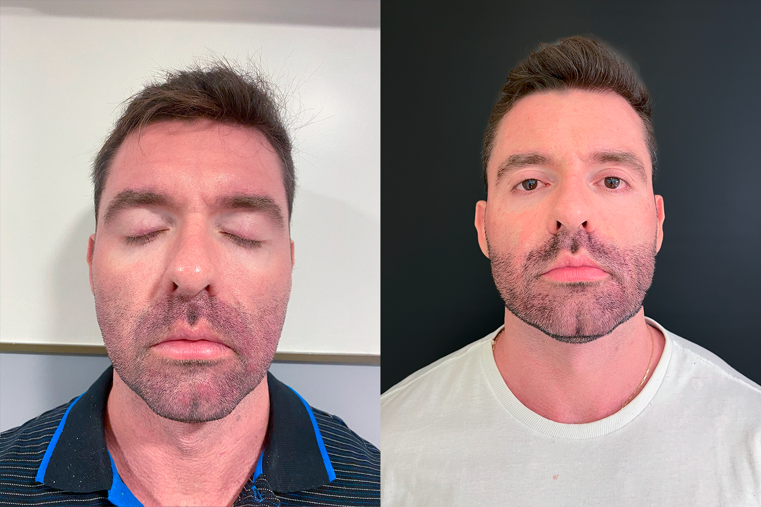 PROTOCOLO LM BEAUTY - ANTES E DEPOIS 2