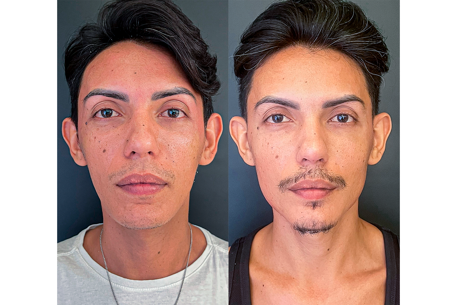 PROTOCOLO LM BEAUTY - ANTES E DEPOIS 3