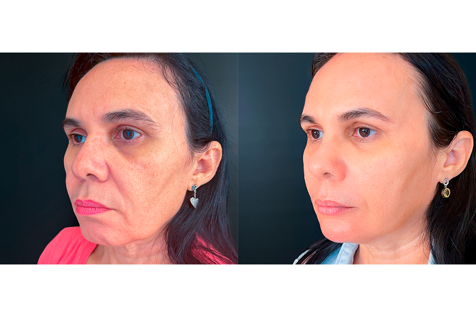 PROTOCOLO LM BEAUTY - ANTES E DEPOIS 4