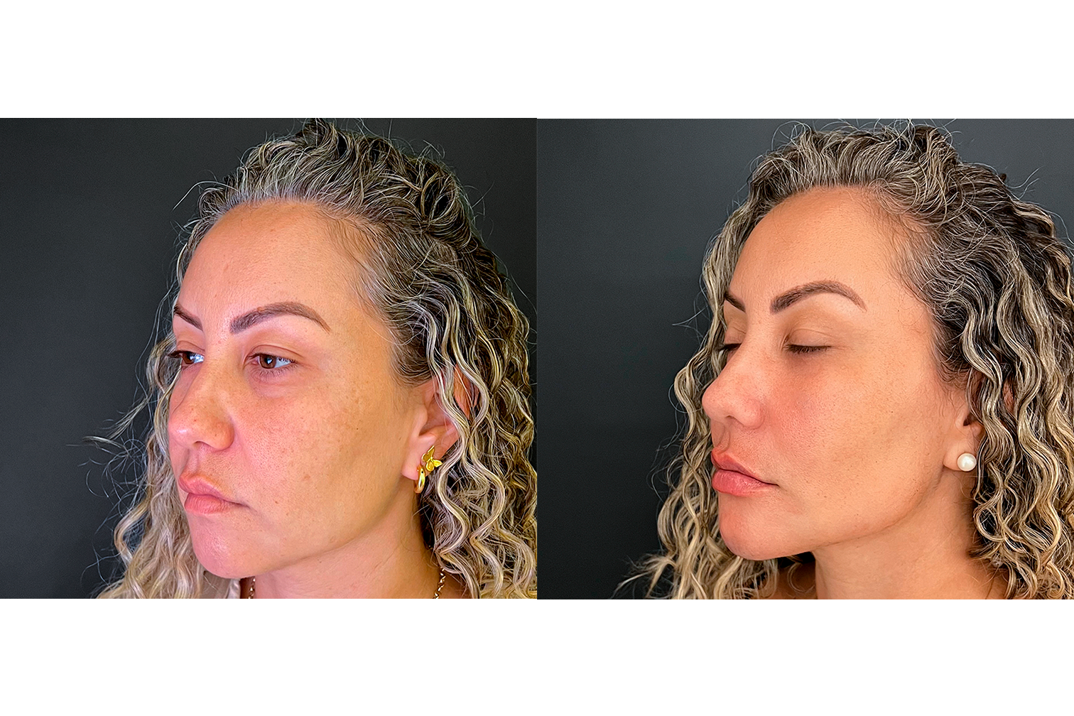 PROTOCOLO LM BEAUTY - ANTES E DEPOIS 5