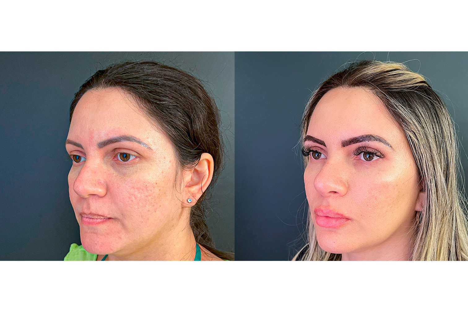 PROTOCOLO LM BEAUTY - ANTES E DEPOIS 6
