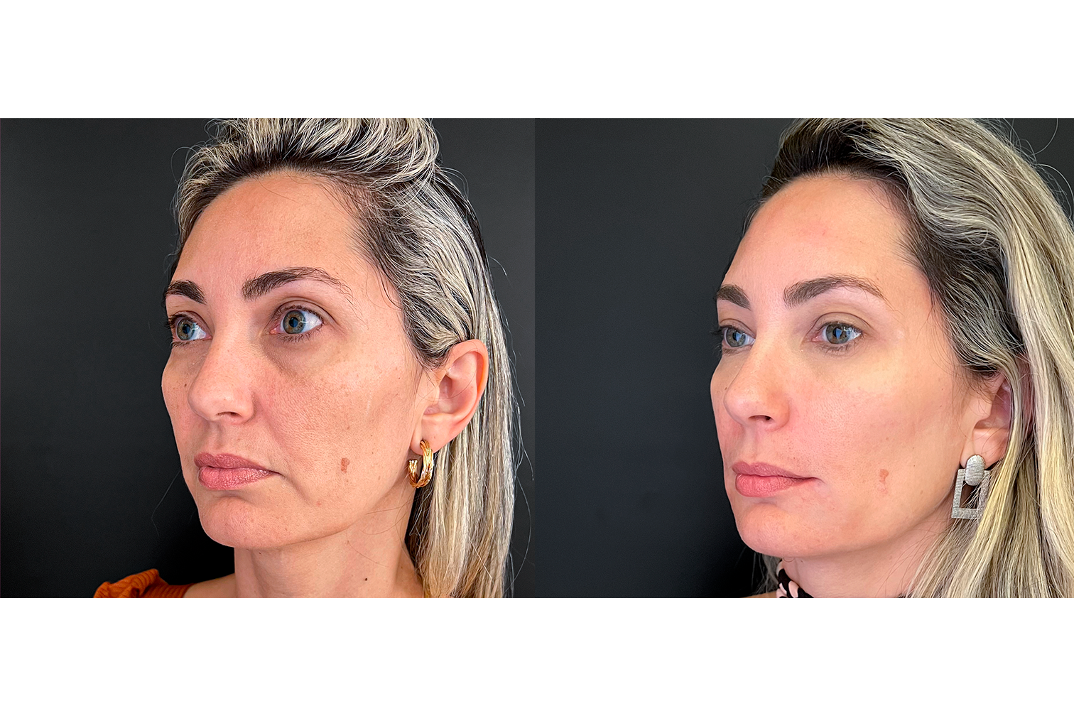 PROTOCOLO LM BEAUTY - ANTES E DEPOIS 7