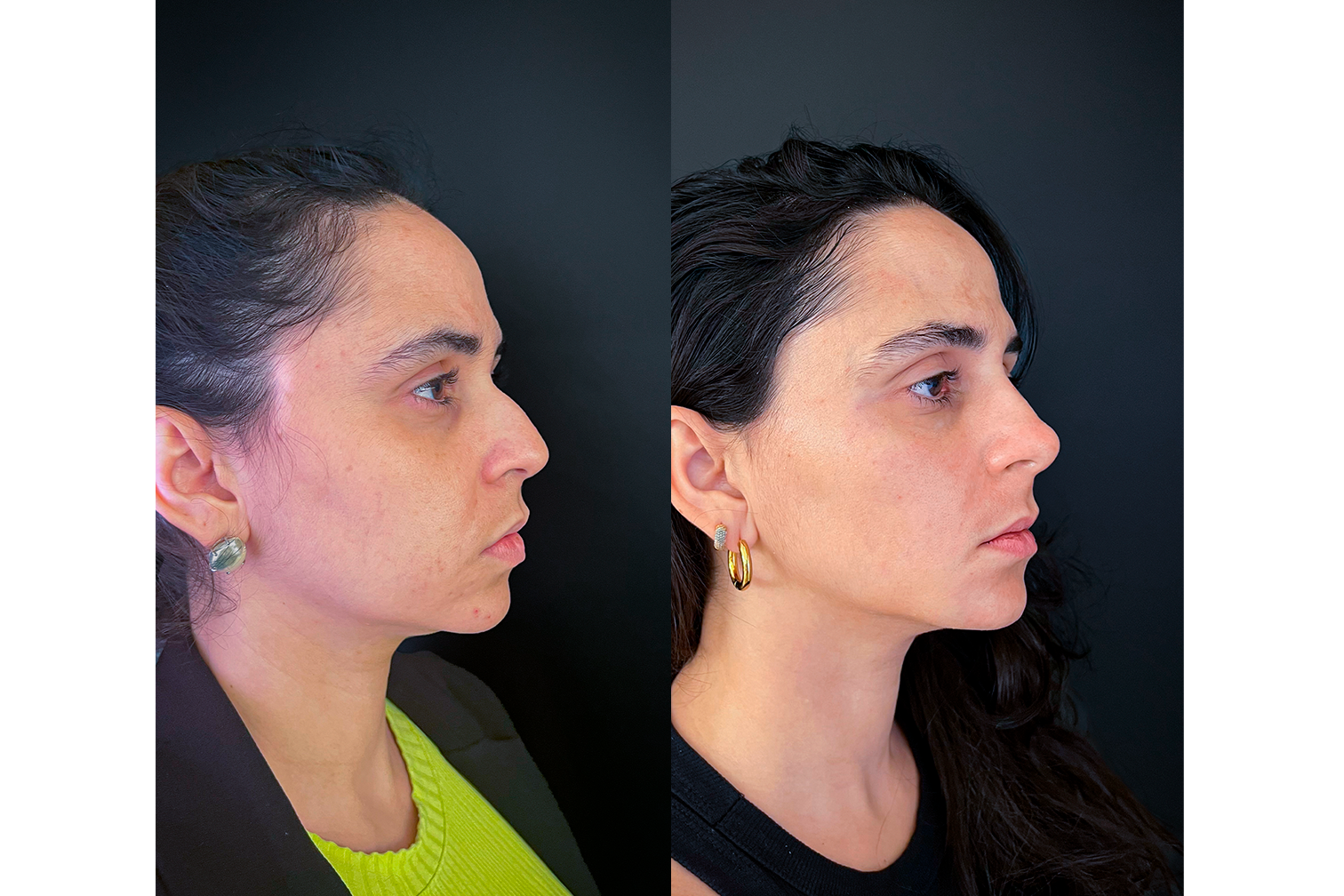PROTOCOLO LM BEAUTY - ANTES E DEPOIS 8