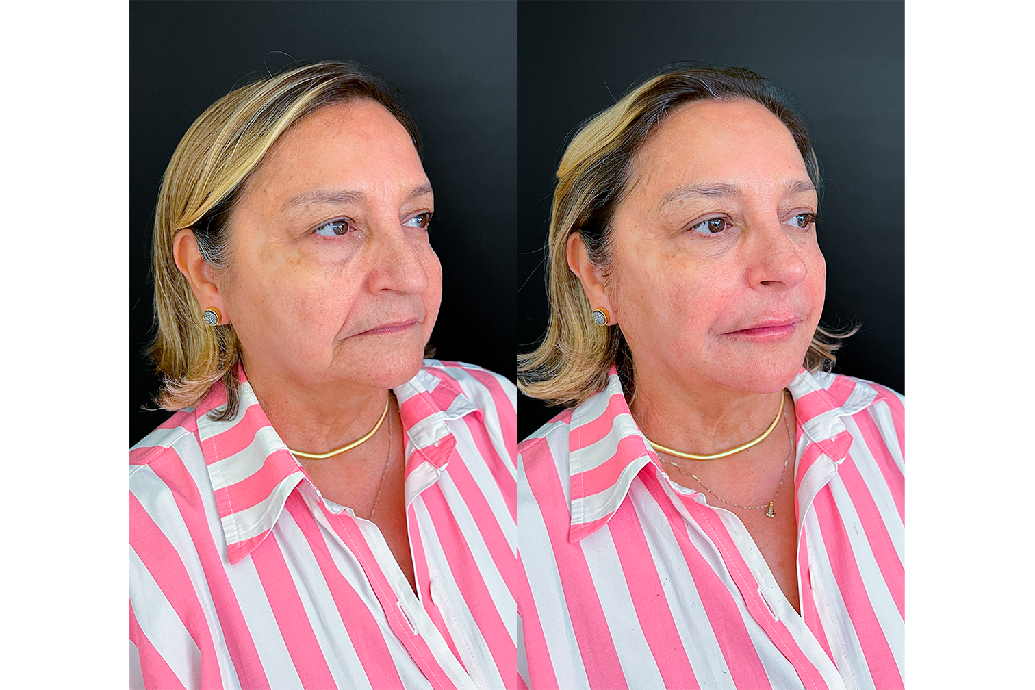 PROTOCOLO LM BEAUTY - ANTES E DEPOIS 9